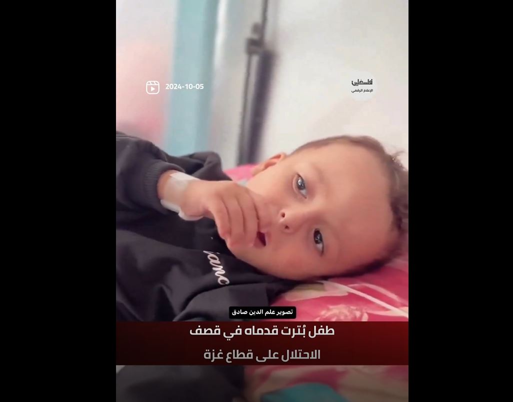 Video: Children in Gaza losing legs before learning how to walk 