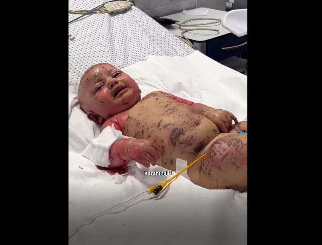 Heartbreaking scene shows a Palestinian baby suffering from severe burns after Israeli attack in northern Gaza