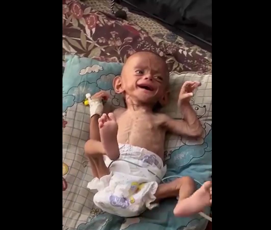 Video: A Palestinian child suffers from dehydration, malnutrition in a tent camp in south Gaza 