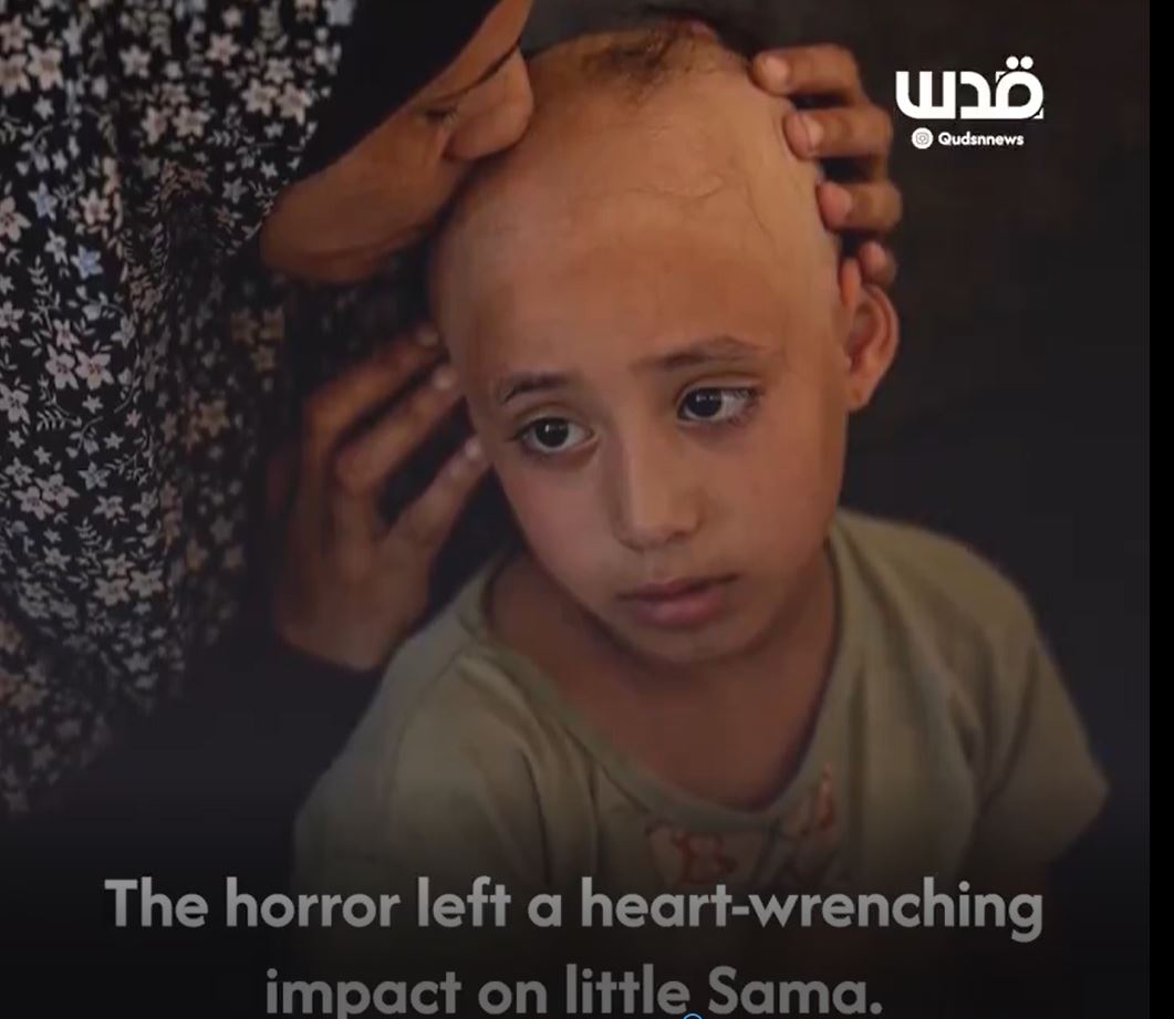 فيديو | طفلة فلسطينية تفقد شعرها بسبب صدمة نفسية نتيجة غارات صهيونية على غزة