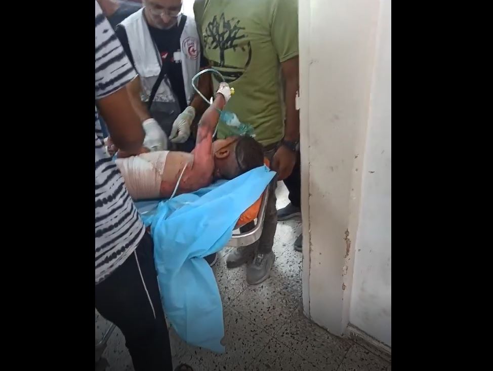 Video: A Palestinian child sustained severe burns following Israeli massacre in Al-Zaytoun School, Gaza