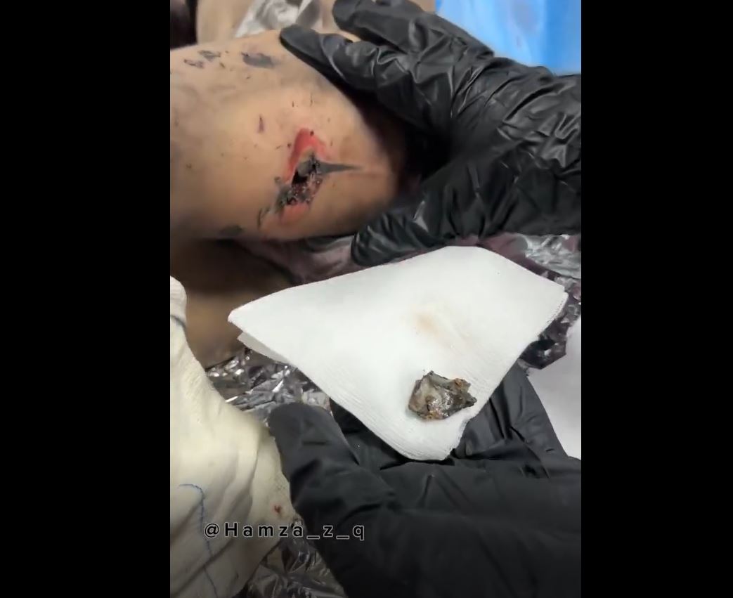 Sensitive Video: Palestinian toddler sustains injuries due to an Israeli air attack east of Gaza City