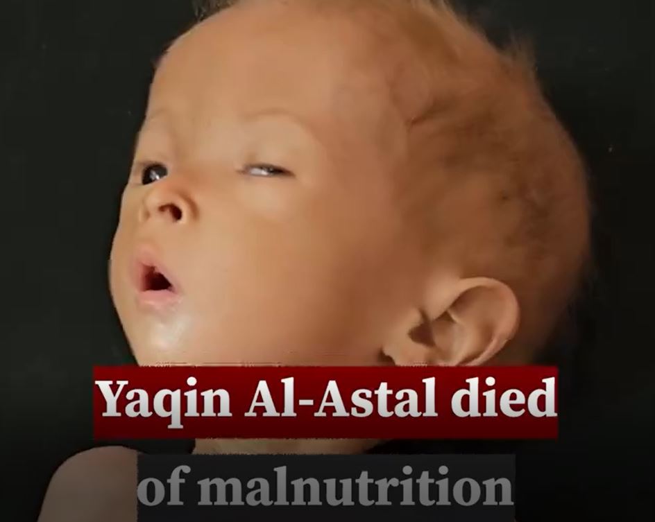 Video: Palestinian infant succumbed to malnutrition exacerbated by Israel's inhumane blockade of Gaza 