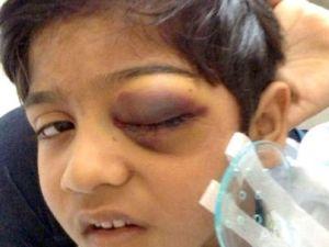 قلقون من تعرض أحمد لمضاعفات بعد استئصال عينه