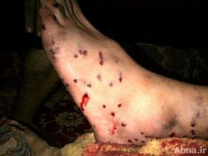 مرتزقة النظام البحريني تعذب شاباً أصابته بسلاح "الشوزن"