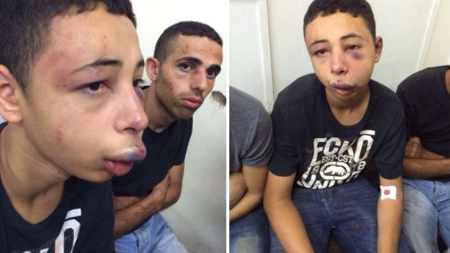  Israeli Forces Brutally Beat Palestinian-American Teenager + Pics