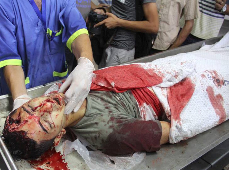 ارتفاع عدد الشهداء الى 82 وجرح أكثر من 535 في قطاع غزة