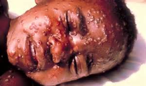 افریقی ممالک ایبولا ebola کا مقابلہ کرنے کے لئے کوشاں
