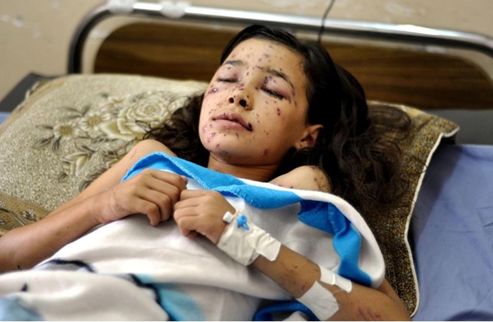 طفلة فلسطينية تغمض عينيها خوفا من القصف الاسرائيلي ولا تستطيع فتحهما ثانية
