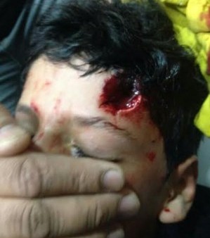 شاب بحریني يعاني من نزيف في المخ سببه رصاص آل خلیفة