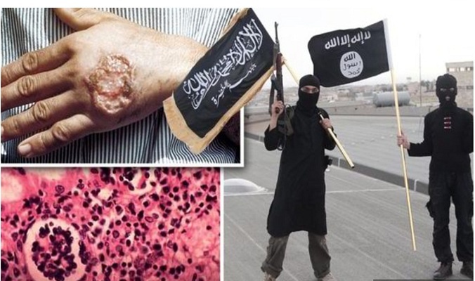 إصابة 100 الف "داعشي" بمرض طفيلي يؤدي لتآكل لحومهم
