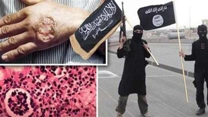 الكشف عن سبب الوباء الجلدي الذي يفتك بتنظيم «داعش»!