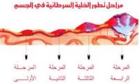 الولايات المتحدة وأدائها الضعيف في علاج السرطان