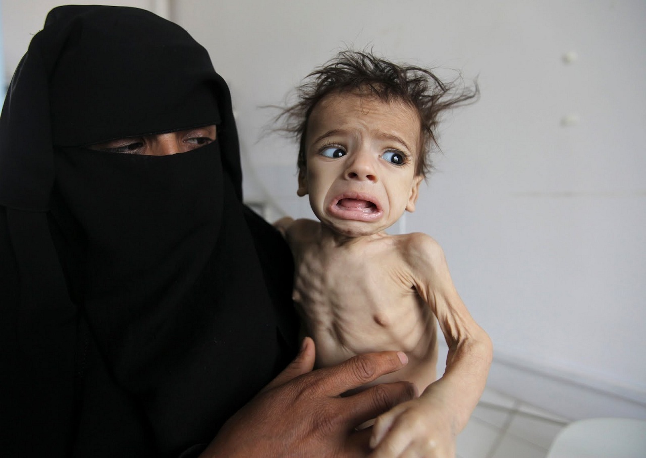 El Sistema Sanitario se Derrumba y las Enfermedades Matan cada vez a Más Yemeníes