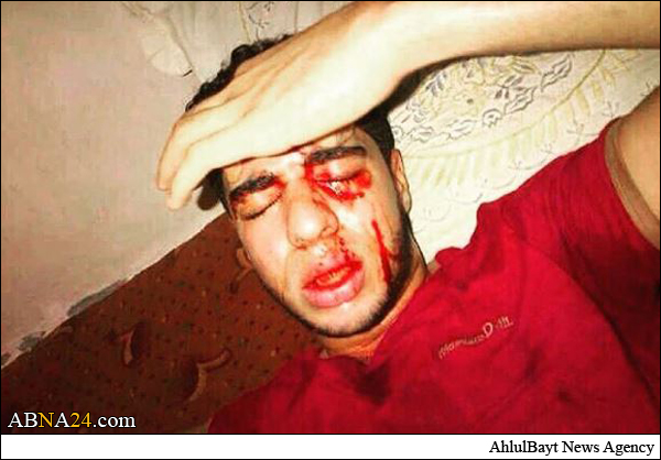 السلطات الخليفية تحرم المعتقل الجريح حبيب علاوي من العلاج + (صور)
