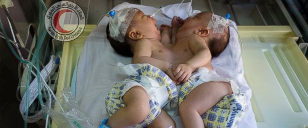 Syria’s conjoined twins die of heart failure