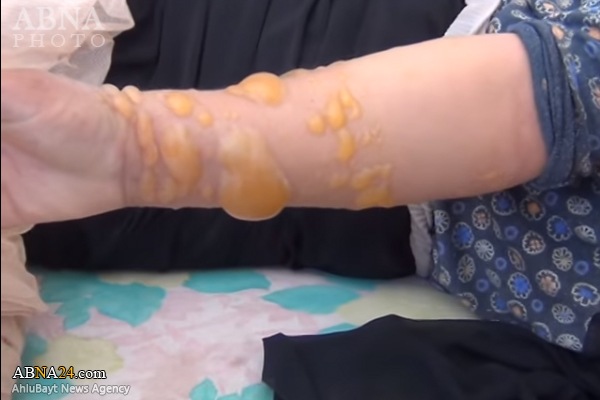 تصویری رپورٹ/ داعش کا حلب کے دو قصبوں پر کیمیاوی حملہ
