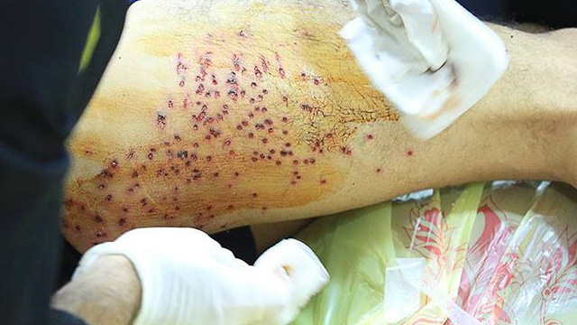 إصابة أكثر من 37 مواطنا شاركوا في تظاهرات سلمية بالبحرين +(صور)
