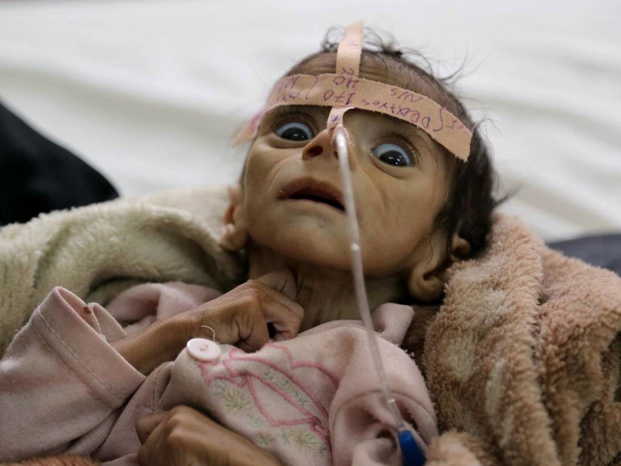 ONU: Yemen Testigo de la Mayor Tragedia Humanitaria y Peligro de Hambruna Debido a la Continuación de la Guerra Saudí