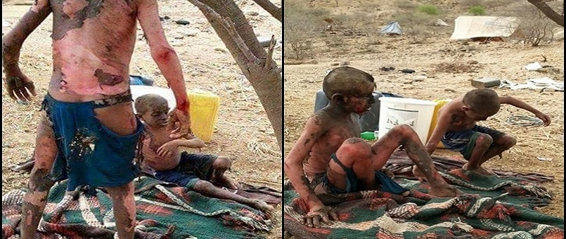 Suudi Rejim Yemen'de Çocukların Geleceğini Hedef Alıyor
