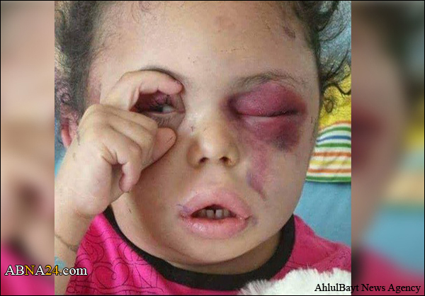بثينة التي حاولت فتح عينها الجريحة فتحت عيون العالم على جرائم السعودية في اليمن + (صور)