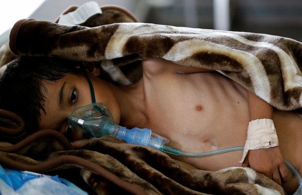 Epidemija kolere u Jemenu je saudijsko-američko-izraelski čin bioterorizma