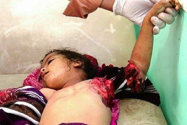 استشهاد وجرح 6 مدنيين بينهم 4 أطفال بصعدة+(صورة)