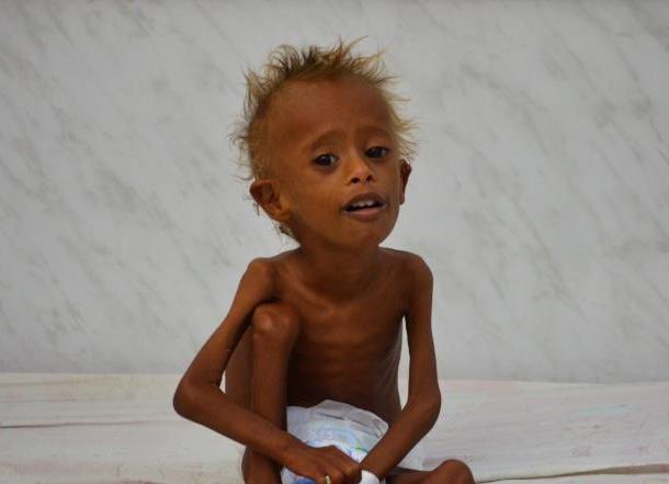 أكثر من 50 ألف طفل يمني معرّضون للموت بحلول نهاية العام