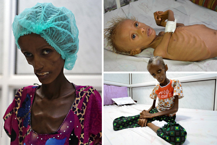 UNICEF: Yemen worst place on earth to be a child