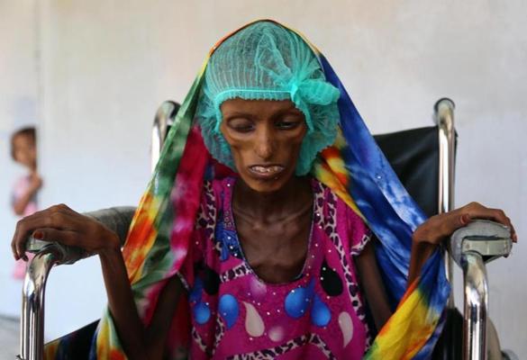 ONU: Yemen Vive una Situación muy Parecida al ‘Apocalipsis’ 