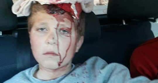 Israeli soldiers shoot Palestinian child with 'Gas Bomb' In head near Ramallah