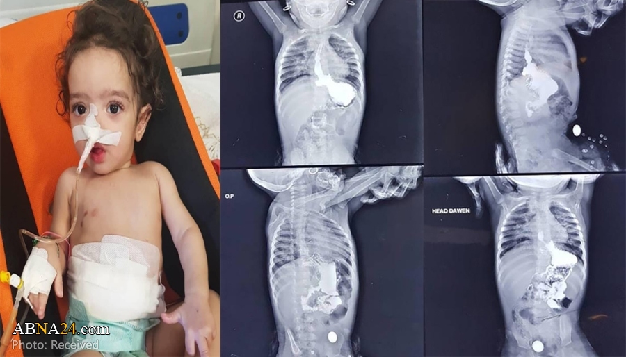 Rare, complicated surgery goes successful in Karbala hospital on one-year-old girl