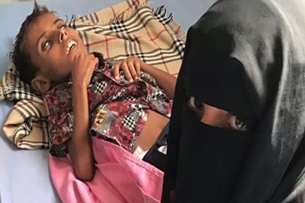 イエメンの１０歳の少年がフダイダ港の封鎖により餓死