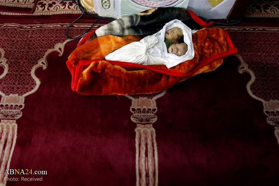 Tragic death of conjoined infant twins due Saudi siege of Yemen/ Pics