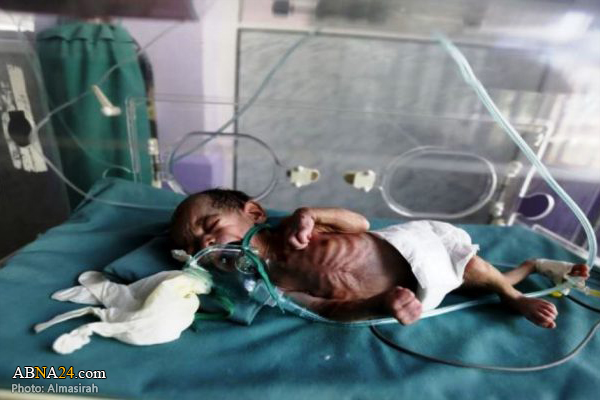 Saudi missiles on Yemen produce generation of deformed babies
