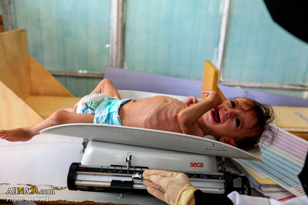 Malnutrition d'enfants yéménites à Sanaa