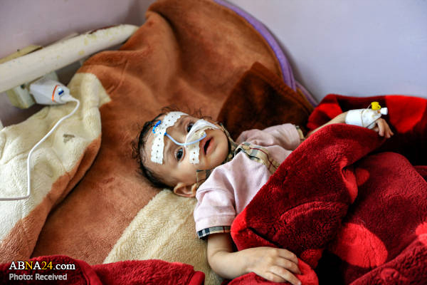 La desnutrición de los niños yemeníes en Sanaá