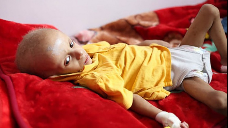 イエメン保健省、「イエメンで１０分ごとに一人の子どもが死亡」