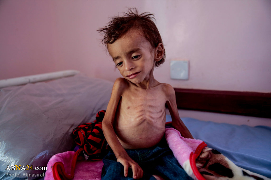 Yemeni children pay price for Saudi blockade