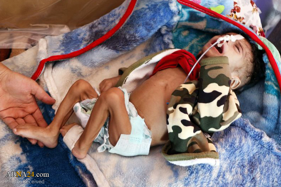 World Health Organization: 18 million Yemenis in risk of malaria