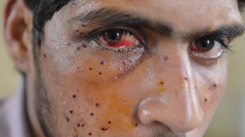 Human Rights Watch fordert ein Verbot von Pellet-Gewehren in Kaschmir