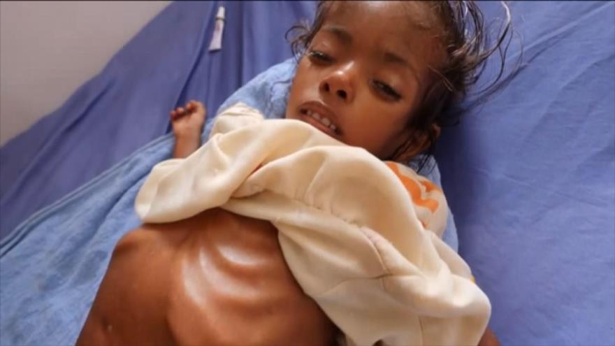“Un ONG advierte que la crisis alimentaria de Yemen podría ser una sentencia de muerte para sus niños” 