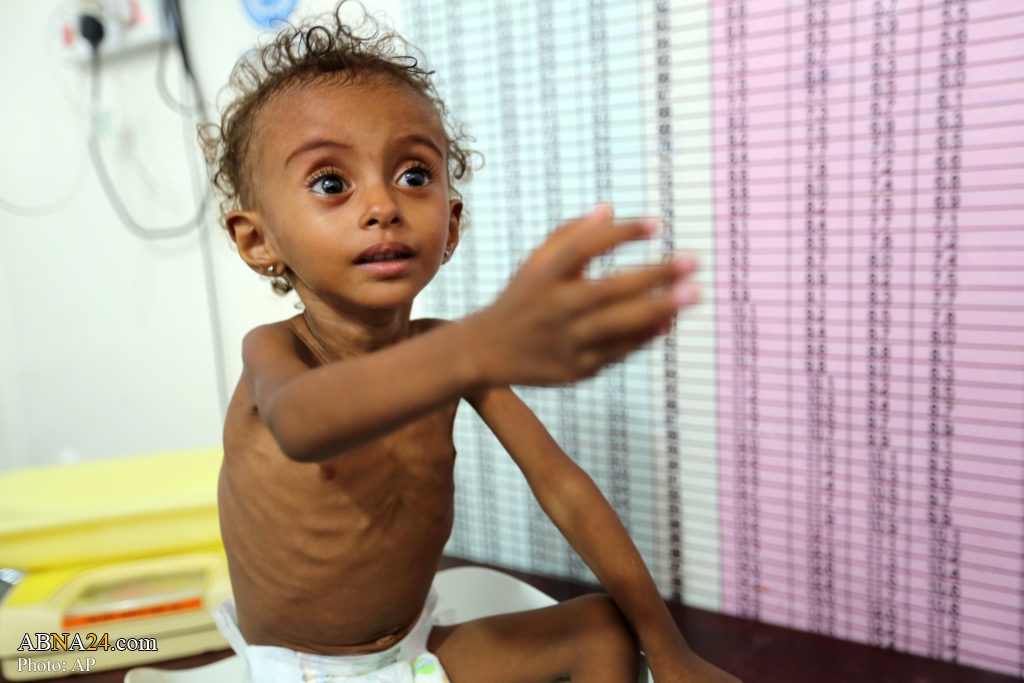 UN: Half of Yemen children under 5 will suffer from malnutrition in 2021