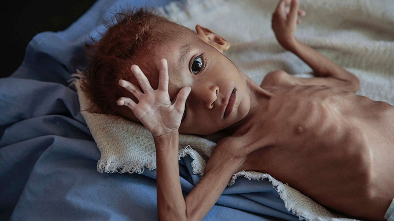 UN: Watoto wasiopungua laki nne wako hatarini kufa kwa njaa mwaka huu nchini Yemen