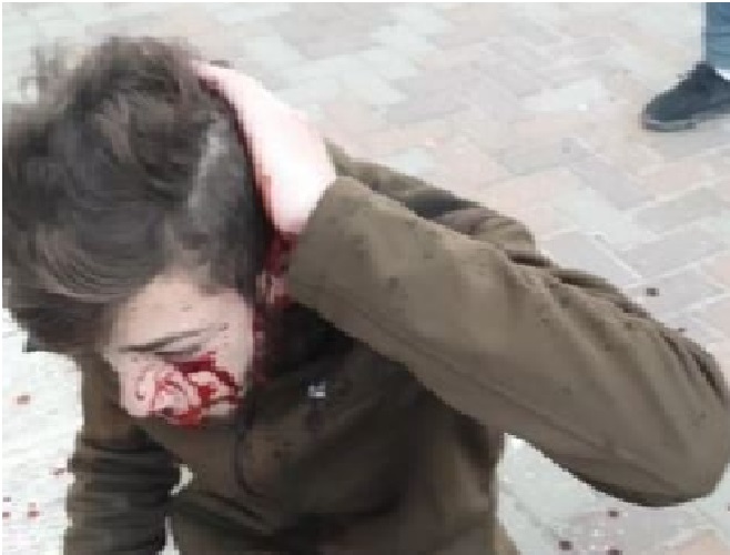 “Niño palestinos herido en la cabeza por colonos sionistas”