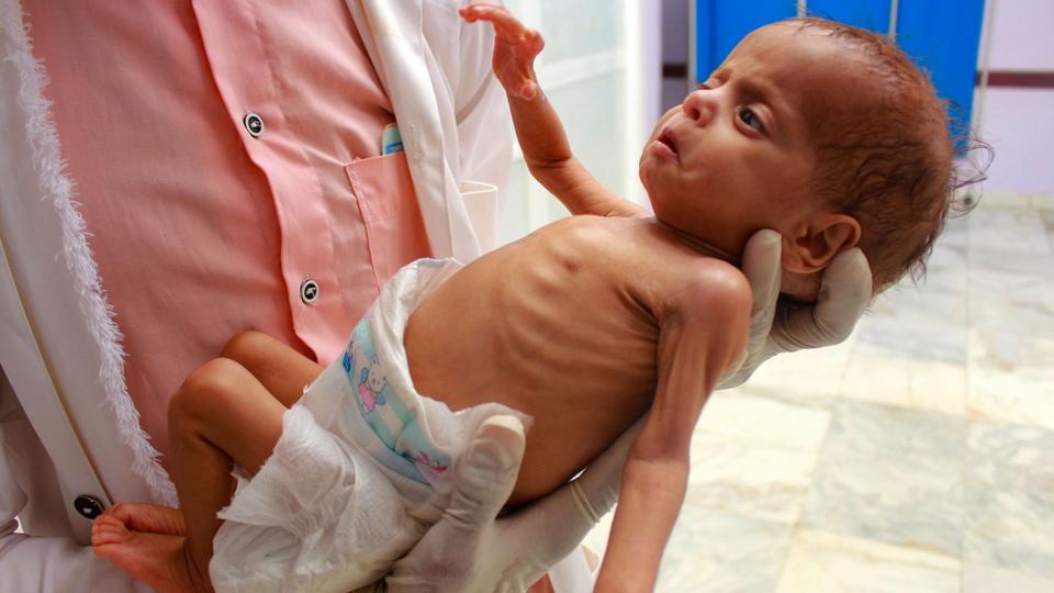 75% of Yemeni children are chronically malnourished: WHO