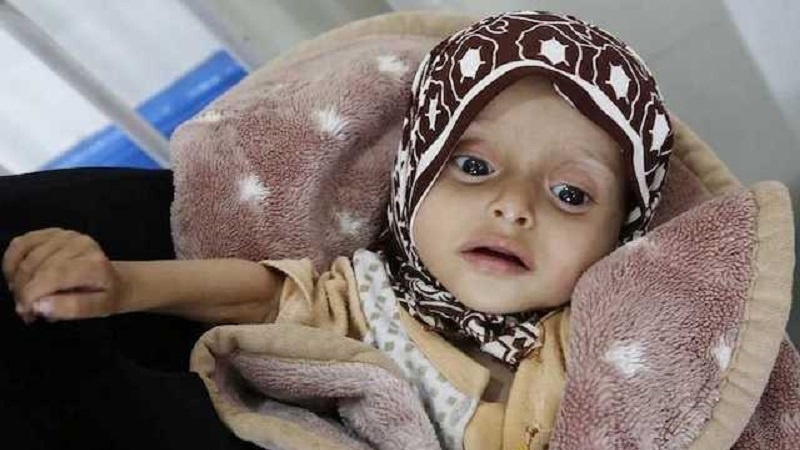 Yemen, il 75% dei bambini è cronicamente malnutrito