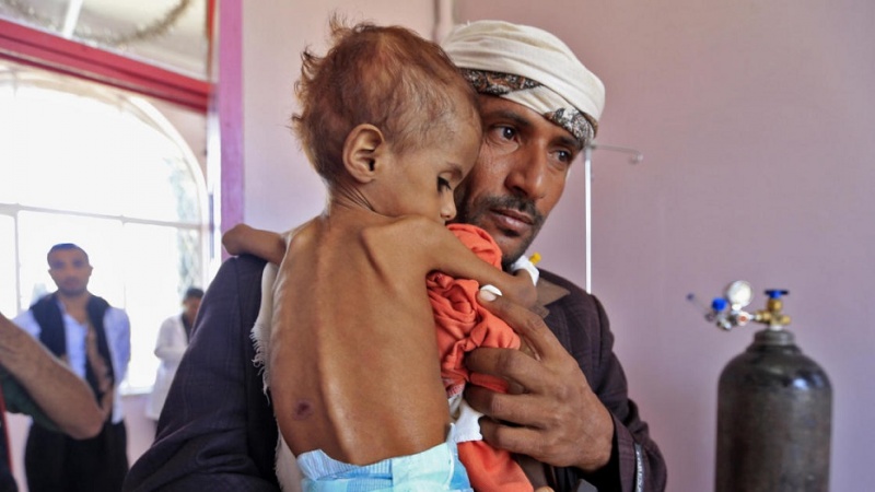 Watoto 300 wa Yemen wanaaga dunia kila siku kwa utapiamlo