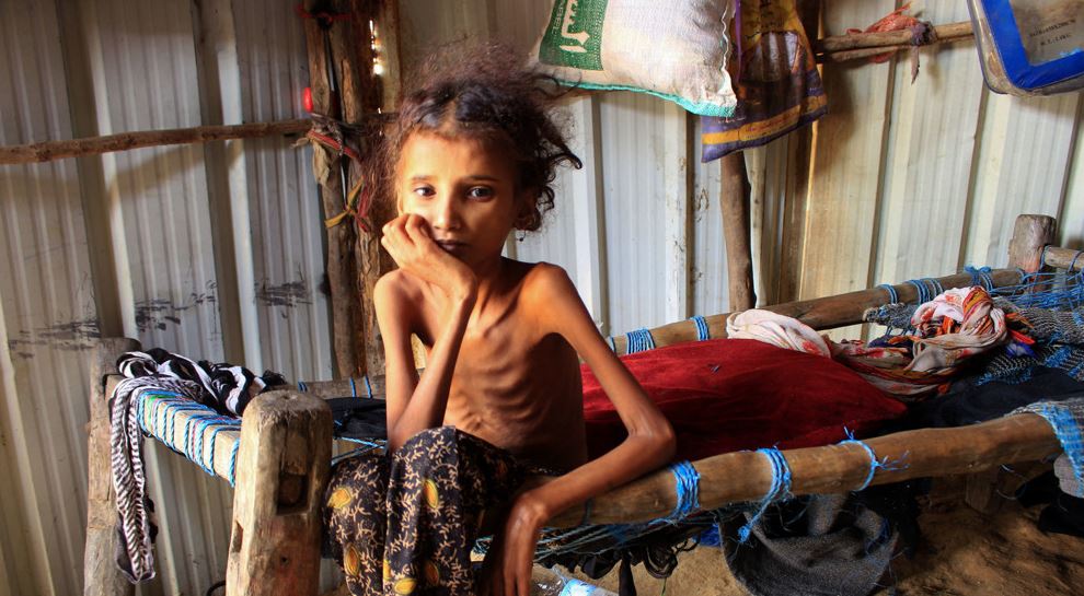 Oppressed Yemen suffers world's worst epidemic disaster from Saudi war